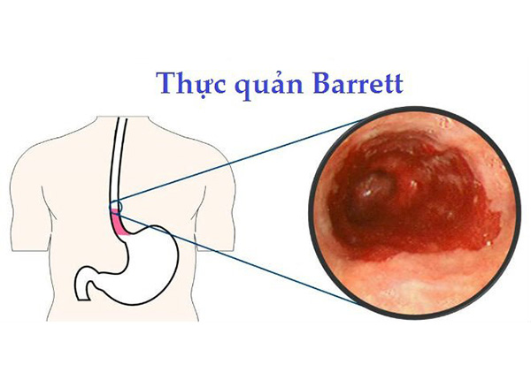 Barrett thực quản là một bệnh lý của hệ tiêu hóa