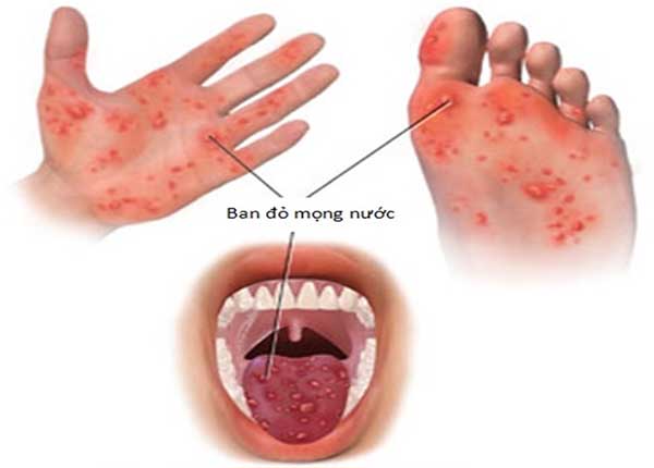 Bệnh tay chân miệng là bệnh truyền nhiễm lây từ người sang người