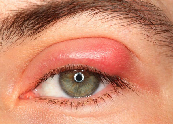 Bệnh viêm xoang gây nên tình trạng áp xe ổ mắt