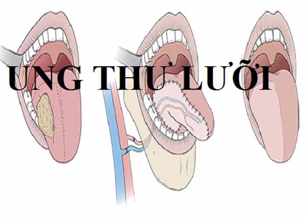 Ung thư lưỡi là một căn bệnh thường thấy liên quan đến khoang miệng