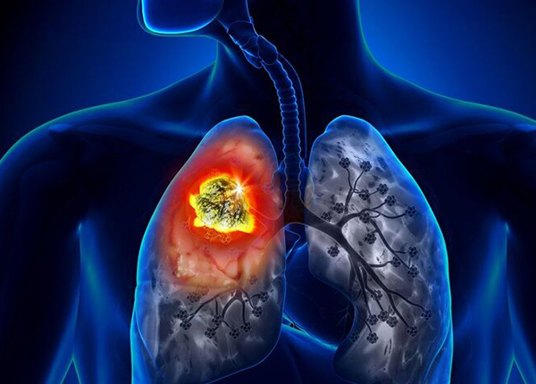 Ung thư phổi phổ biến và gây tử vong cao do phát hiện bệnh muộn