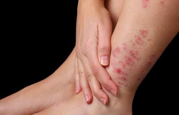 Viêm da cơ địa là một trong những bệnh lý về da phổ biến hiện nay